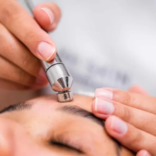 Peeling de diamante — exfoliación y renovación de la piel